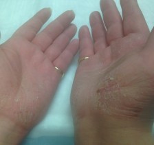 Hand Eczema Triggered by Hand Sanitizers in a Health Care Worker