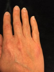 Nummular Eczema on my hand